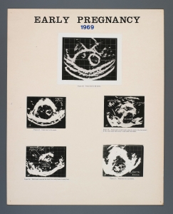 004_early_pregnancy_1969