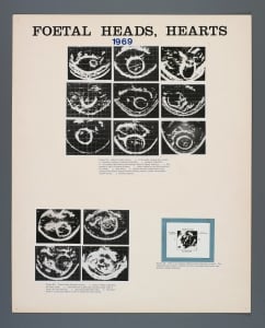 013_fetal_head_heart