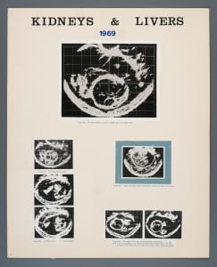 014_kidney_liver_1969