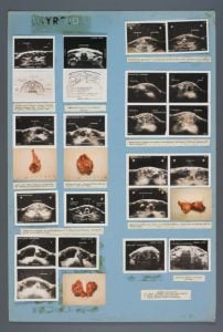 019_thyroid