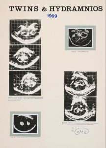020_twins_hydramnios_1969