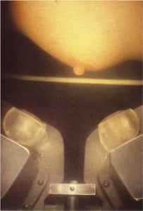 Breast scan using the System I