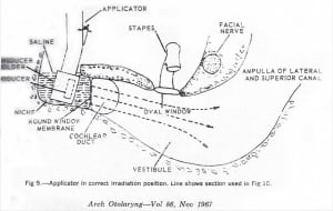 Meniere's treatment details