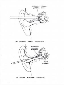 Meniere's treatment details