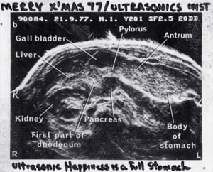 1977 liquid-filled stomach