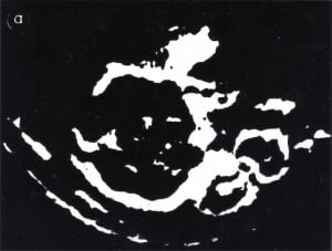 Early obstetric echogram (1962)