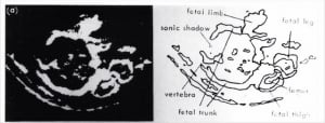 Early obstetric echogram (1962)