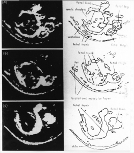 Early fetal scan (1962)