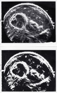 Normal fetal chest