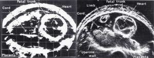 Fetal heart, bistable/greyscale comparison