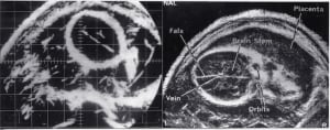 Fetal head, bistable/greyscale comparison