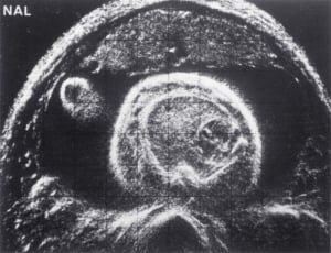 Fetal lung tumour