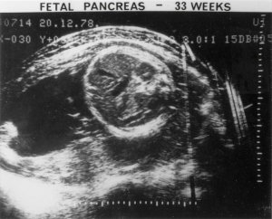 Fetal pancreas, Octoson image (1978)