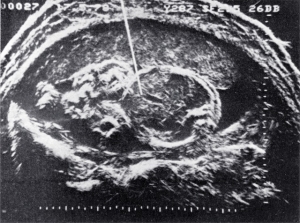 Early Doppler flow measurement (1978)