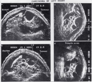Carcinoma of left ovary (1980?)