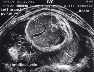 Umbilical vein anatomy (1978)