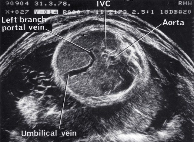 Umbilical vein anatomy (1978)