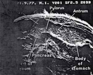 Stomach filled with methylcellulose suspension to show stomach bed (1977)