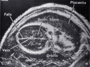 Normal fetal brain (1972)