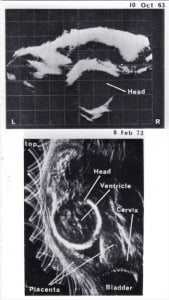 Normal fetal head (1963 and 1973)