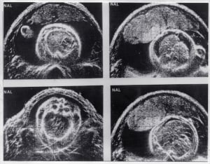 Fetal lung tumour (1974)