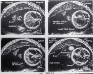 Fetal gut atresia (1974)