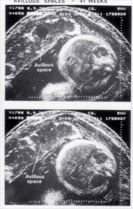 Placental avillous spaces at 41 wks (1978)