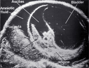 Needle aspiration of fetal ascites (1974)