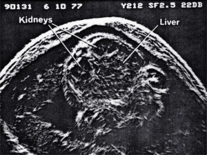 UI Octoson normal fetal anatomy (1977)