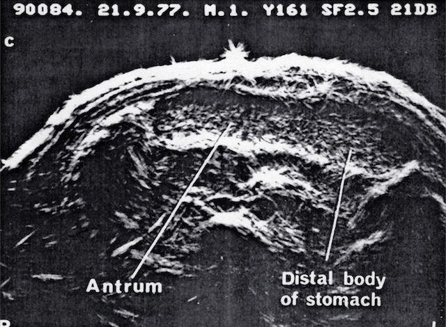UI Octoson fluid filled stomach as window to pancreas (1977)