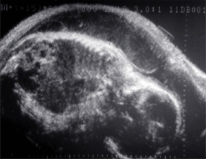 Multicystic fetal kidney at term (1978)