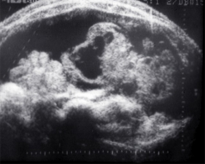 Ovarian carcinoma (1980)
