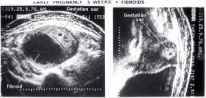 5 week pregnancy with fibroids (1978)