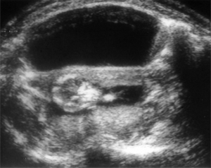1 of 4 images. Shows uterine compliance with full bladder (1984)