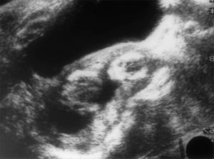2 of 4 images. Shows uterine compliance with full bladder (1984)