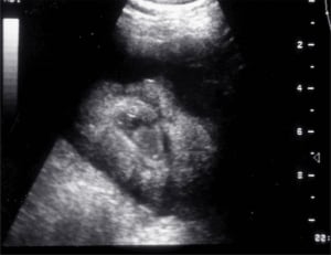 Quasi-3D cleft palate, Nepean Hospital (1994)