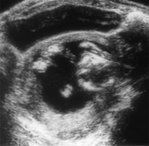 3 of 4 images. Bladder partly emptied (1984)