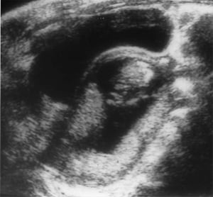 4 of 4 images. Bladder partly emptied (1984)