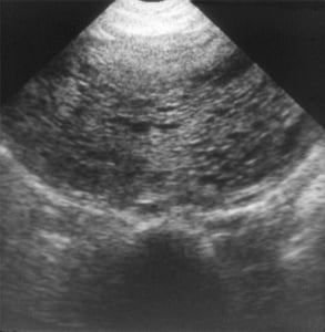 Hydatidiform mole (1988)