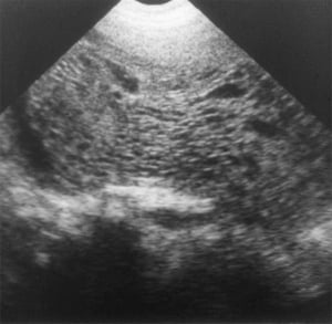 Hydatidiform mole (1988)