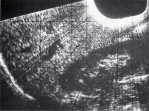 Simple sector scan upper right abdomen - contact machine