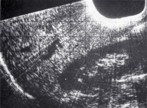 Simple sector scan upper right abdomen - contact machine