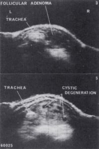 Thyroid