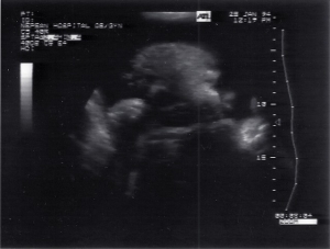 Quasi-3D normal fetus, Nepean Hospital (1994)