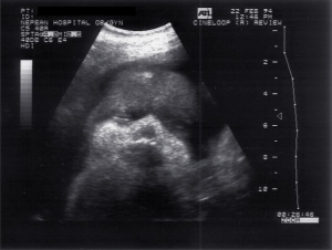 Quasi-3D normal fetus, Nepean Hospital (1994)