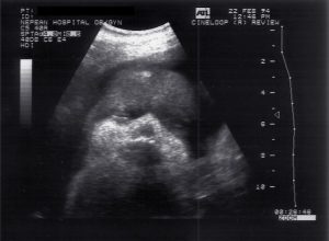 Quasi-3D normal fetus, Nepean Hospital (1994)