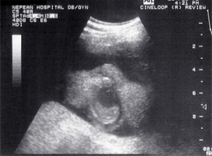 Quasi-3D cleft palate, Nepean Hospital (1994)