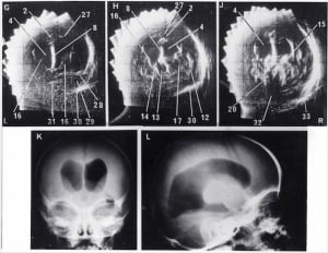 Comparison of echograms and pneumoencapholgrams in same baby (1974)