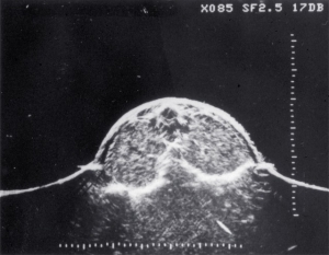 Polycystic kidneys age 1 month (1977)