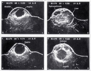 Haematocolpos age 5 weeks (1977)